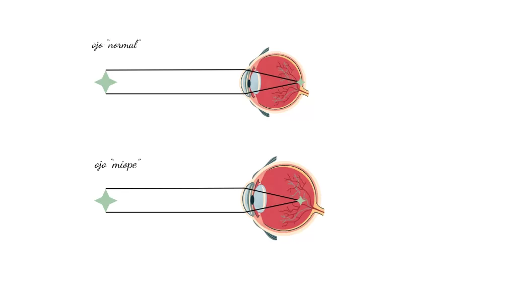 esquema de un ojo normal vs ojo miope